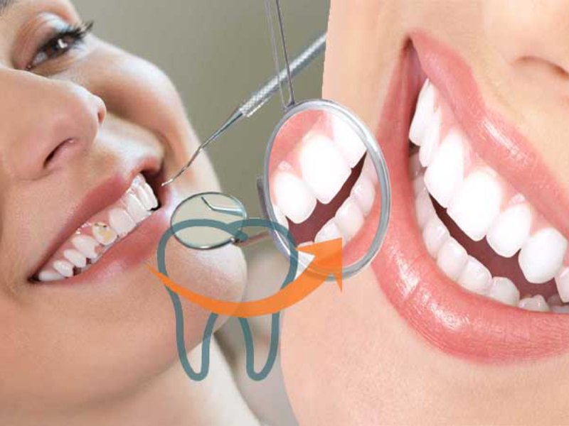 Dental Implants
