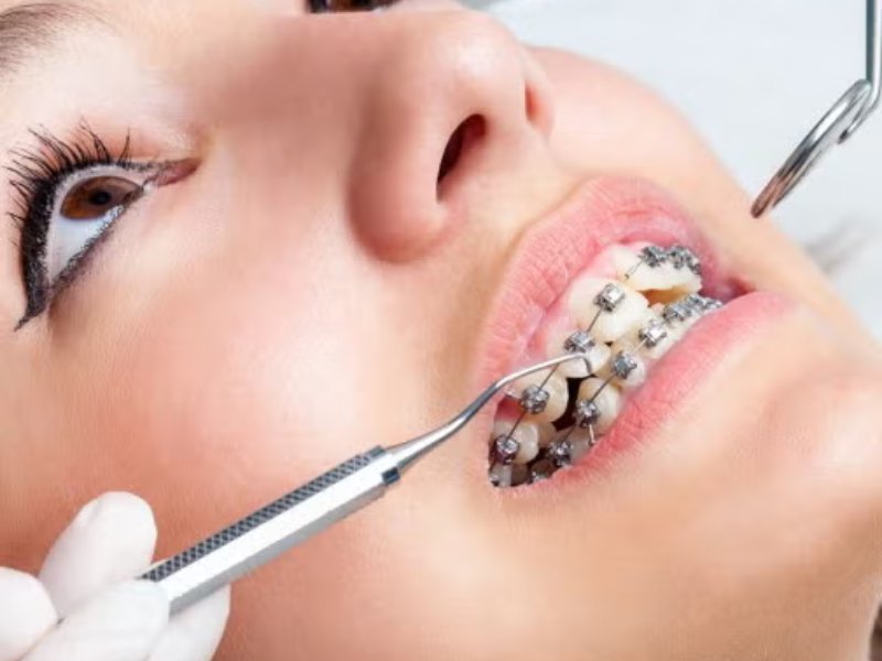 Dental Implants