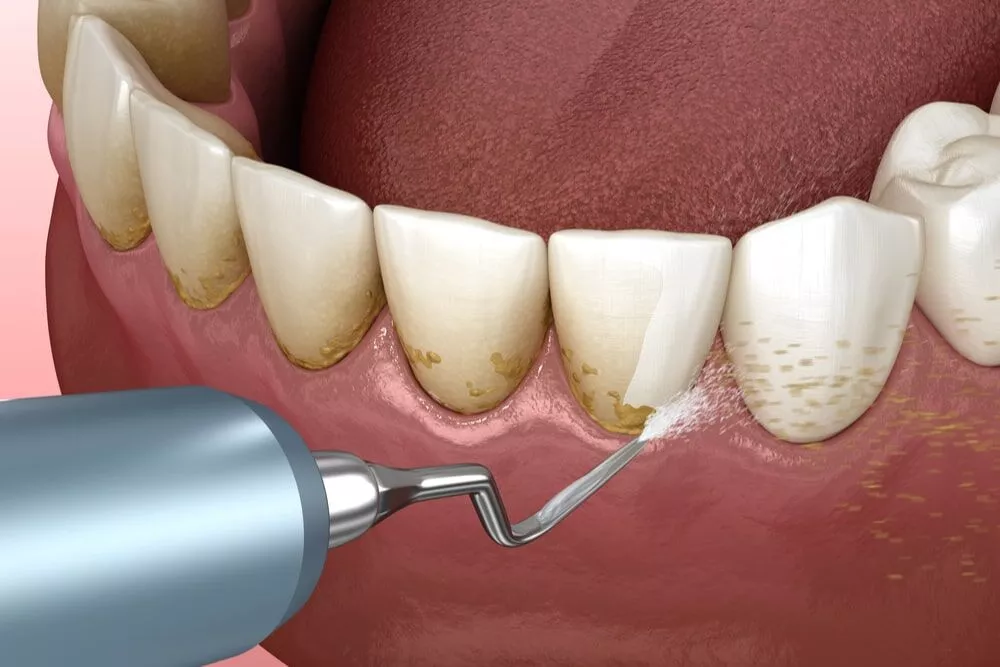 Dental Implants